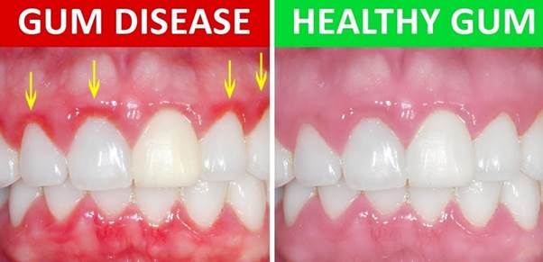 نشانه های دندان و لثه سالم
